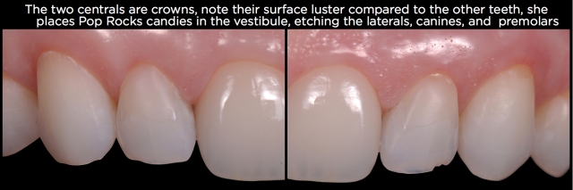 Where, Oh Where, Did That Tooth Wear Come From? Part 2 Frank Spear Where Oh Where Did That Tooth Wear Come From Part 2 Figure 11