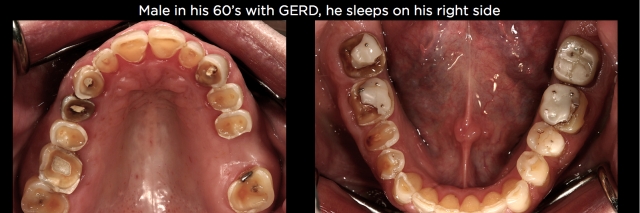 Where, Oh Where, Did That Tooth Wear Come From? Part 2 Frank Spear Where Oh Where Did That Tooth Wear Come From Part 2 Figure 2