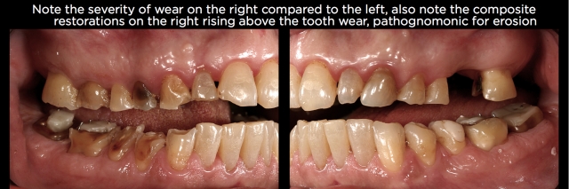Where, Oh Where, Did That Tooth Wear Come From? Part 2 Frank Spear Where Oh Where Did That Tooth Wear Come From Part 2 Figure 3