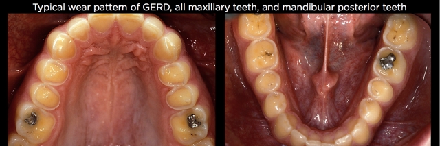 Where, Oh Where, Did That Tooth Wear Come From? Part 2 Frank Spear Where Oh Where Did That Tooth Wear Come From Part 2 Figure 4