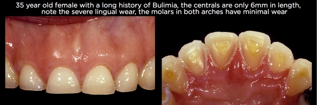 Where, Oh Where, Did That Tooth Wear Come From? Part 2 Frank Spear Where Oh Where Did That Tooth Wear Come From Part 2 Figure 5