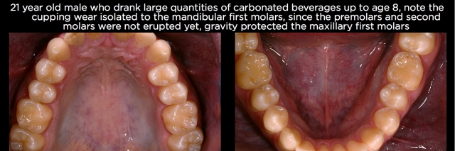 Where, Oh Where, Did That Tooth Wear Come From? Part 2 Frank Spear Where Oh Where Did That Tooth Wear Come From Part 2 Figure 7