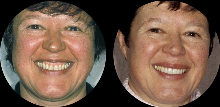 Post-Pandemic Dentistry: Bruxism, Tooth Wear, and Communication FrankSpear Postpandemic dentistry treating bruxism wear Fig.10