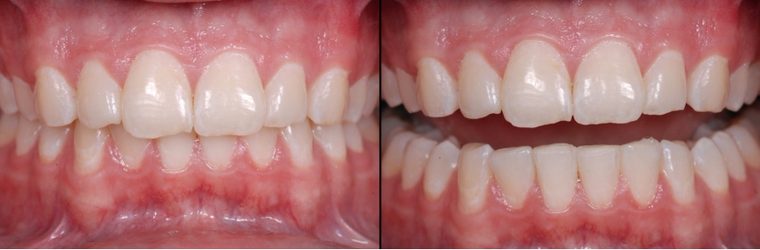 Post-Pandemic Dentistry: Bruxism, Tooth Wear, and Communication FrankSpear Postpandemic dentistry treating bruxism wear Fig.11