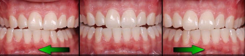 Post-Pandemic Dentistry: Bruxism, Tooth Wear, and Communication FrankSpear Postpandemic dentistry treating bruxism wear Fig.12