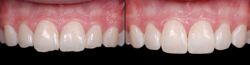 Post-Pandemic Dentistry: Bruxism, Tooth Wear, and Communication FrankSpear Postpandemic dentistry treating bruxism wear Fig.13