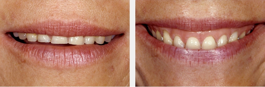 Post-Pandemic Dentistry: Bruxism, Tooth Wear, and Communication FrankSpear Postpandemic dentistry treating bruxism wear Fig.1A