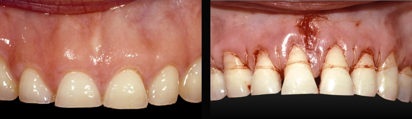 Post-Pandemic Dentistry: Bruxism, Tooth Wear, and Communication FrankSpear Postpandemic dentistry treating bruxism wear Fig.3