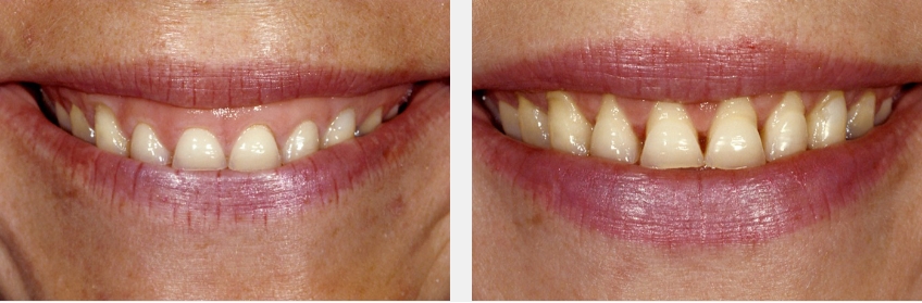 Post-Pandemic Dentistry: Bruxism, Tooth Wear, and Communication FrankSpear Postpandemic dentistry treating bruxism wear Fig.4