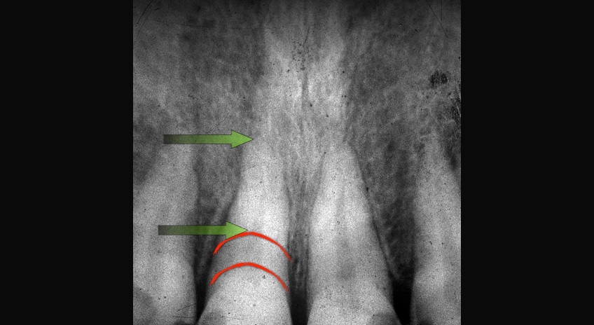 Post-Pandemic Dentistry: Bruxism, Tooth Wear, and Communication FrankSpear Postpandemic dentistry treating bruxism wear Fig.8