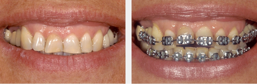 Post-Pandemic Dentistry: Bruxism, Tooth Wear, and Communication FrankSpear Postpandemic dentistry treating bruxism wear Fig.9