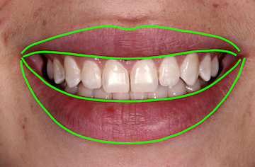 FrankSpear evaluating facial esthetics lip symmetry Fig.2