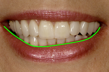 FrankSpear evaluating facial esthetics lip symmetry Fig.3