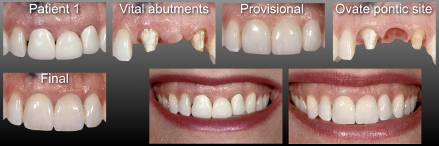 Fixed Partial Dentures vs. Implants, Part I: Is One Better Than the Other? FrankSpear fixed partial dentures vs implants part1 Fig.1