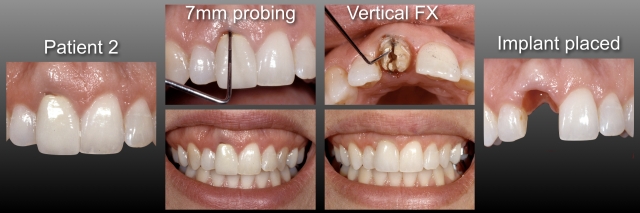 Fixed Partial Dentures vs. Implants, Part I: Is One Better Than the Other? FrankSpear fixed partial dentures vs implants part1 Fig.2