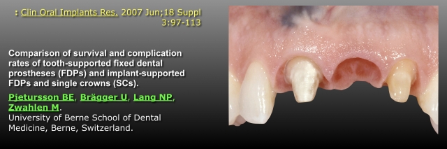 Fixed Partial Dentures vs. Implants, Part I: Is One Better Than the Other? FrankSpear fixed partial dentures vs implants part1 Fig.3