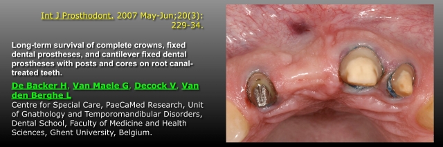 FPDs vs. Implants, Part III: Length of Span and Vitality of Abutments FrankSpear fpds vs implants part 3 vitality of abutments Fig.1