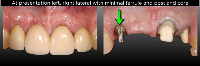 FPDs vs. Implants, Part III: Length of Span and Vitality of Abutments FrankSpear fpds vs implants part 3 vitality of abutments Fig.4