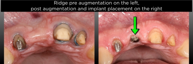 FPDs vs. Implants, Part III: Length of Span and Vitality of Abutments FrankSpear fpds vs implants part 3 vitality of abutments Fig.5