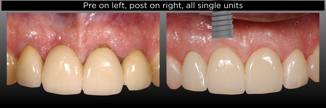 FPDs vs. Implants, Part III: Length of Span and Vitality of Abutments FrankSpear fpds vs implants part 3 vitality of abutments Fig.6
