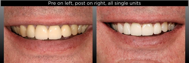 FPDs vs. Implants, Part III: Length of Span and Vitality of Abutments FrankSpear fpds vs implants part 3 vitality of abutments Fig.7