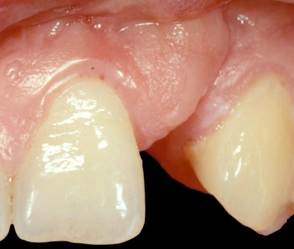 Implants vs. FPDs for Single Anterior Tooth Replacement FrankSpear implants versus fpds for single anterior tooth replacement Fig.1