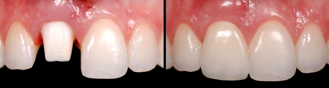 Implants vs. FPDs for Single Anterior Tooth Replacement FrankSpear implants versus fpds for single anterior tooth replacement Fig.10