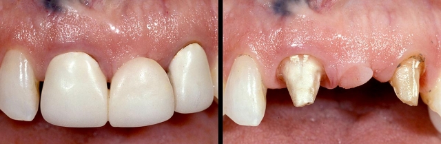Implants vs. FPDs for Single Anterior Tooth Replacement FrankSpear implants versus fpds for single anterior tooth replacement Fig.11
