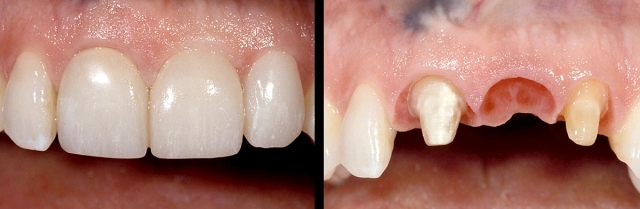 Implants vs. FPDs for Single Anterior Tooth Replacement FrankSpear implants versus fpds for single anterior tooth replacement Fig.12