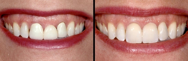 Implants vs. FPDs for Single Anterior Tooth Replacement FrankSpear implants versus fpds for single anterior tooth replacement Fig.13