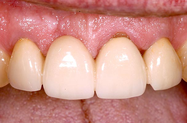 Implants vs. FPDs for Single Anterior Tooth Replacement FrankSpear implants versus fpds for single anterior tooth replacement Fig.14