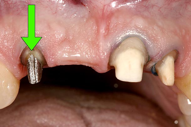 Implants vs. FPDs for Single Anterior Tooth Replacement FrankSpear implants versus fpds for single anterior tooth replacement Fig.15