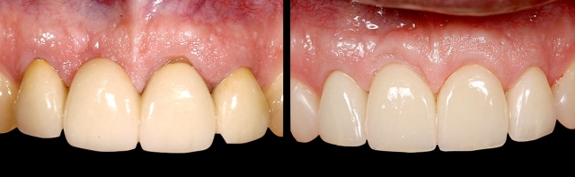 Implants vs. FPDs for Single Anterior Tooth Replacement FrankSpear implants versus fpds for single anterior tooth replacement Fig.16