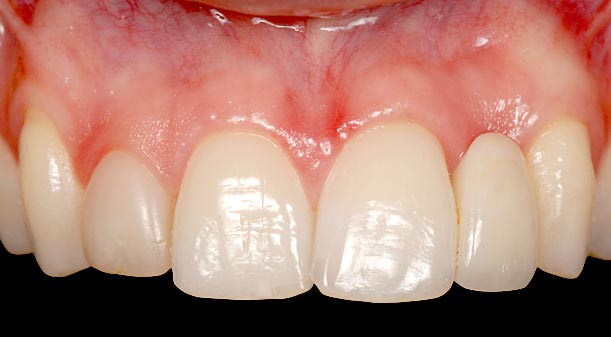 Implants vs. FPDs for Single Anterior Tooth Replacement FrankSpear implants versus fpds for single anterior tooth replacement Fig.17