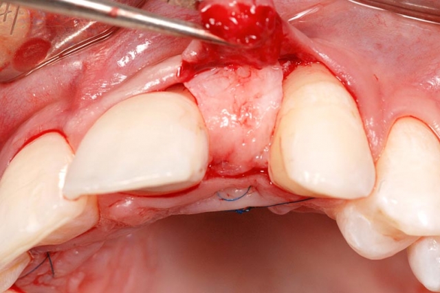 Implants vs. FPDs for Single Anterior Tooth Replacement FrankSpear implants versus fpds for single anterior tooth replacement Fig.18