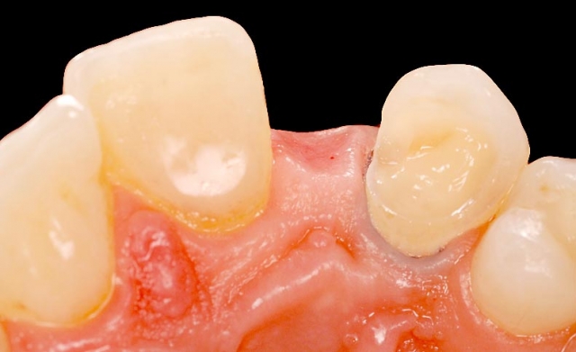 Implants vs. FPDs for Single Anterior Tooth Replacement FrankSpear implants versus fpds for single anterior tooth replacement Fig.19