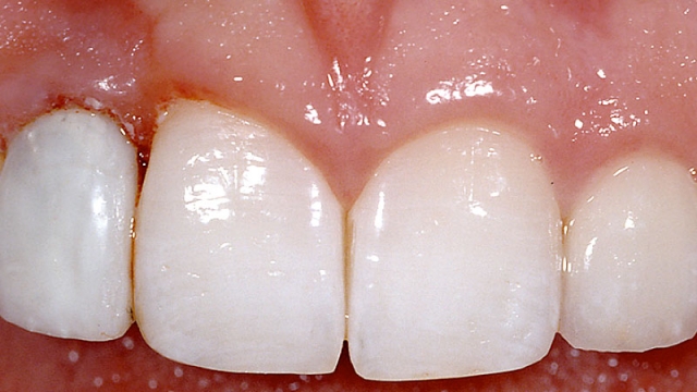 Implants vs. FPDs for Single Anterior Tooth Replacement FrankSpear implants versus fpds for single anterior tooth replacement Fig.2