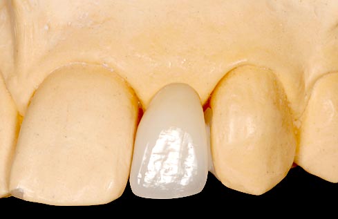 Implants vs. FPDs for Single Anterior Tooth Replacement FrankSpear implants versus fpds for single anterior tooth replacement Fig.20