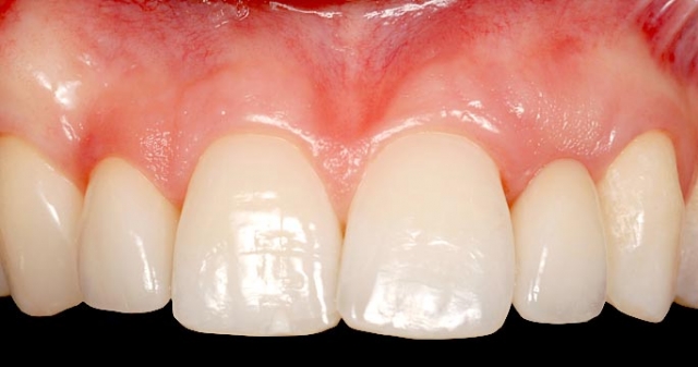 Implants vs. FPDs for Single Anterior Tooth Replacement FrankSpear implants versus fpds for single anterior tooth replacement Fig.21