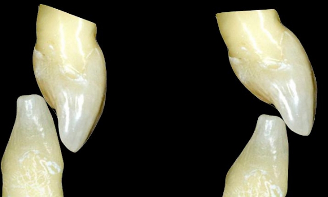 Implants vs. FPDs for Single Anterior Tooth Replacement FrankSpear implants versus fpds for single anterior tooth replacement Fig.22