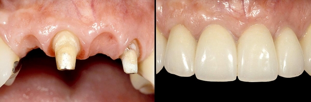 Implants vs. FPDs for Single Anterior Tooth Replacement FrankSpear implants versus fpds for single anterior tooth replacement Fig.23