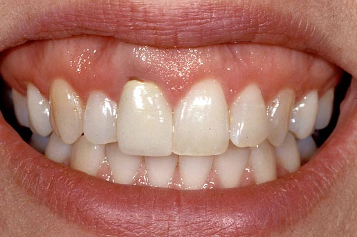 Implants vs. FPDs for Single Anterior Tooth Replacement FrankSpear implants versus fpds for single anterior tooth replacement Fig.24