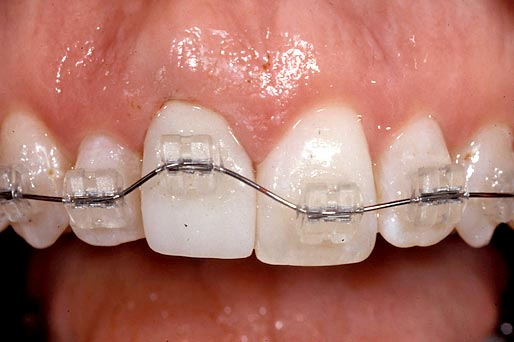 Implants vs. FPDs for Single Anterior Tooth Replacement FrankSpear implants versus fpds for single anterior tooth replacement Fig.25