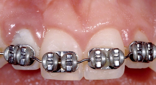 Implants vs. FPDs for Single Anterior Tooth Replacement FrankSpear implants versus fpds for single anterior tooth replacement Fig.3