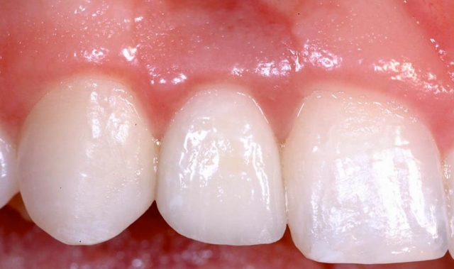 Implants vs. FPDs for Single Anterior Tooth Replacement FrankSpear implants versus fpds for single anterior tooth replacement Fig.4