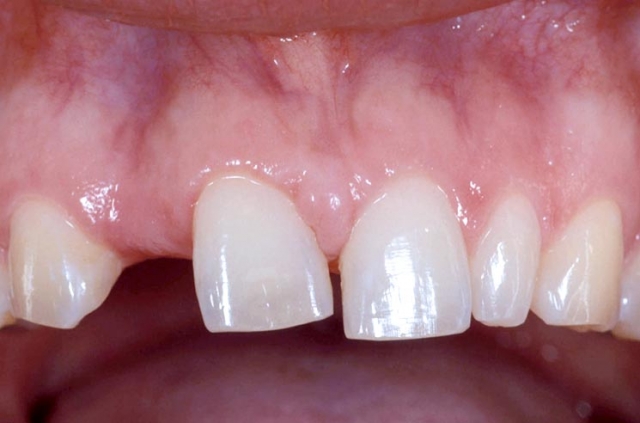 Implants vs. FPDs for Single Anterior Tooth Replacement FrankSpear implants versus fpds for single anterior tooth replacement Fig.5