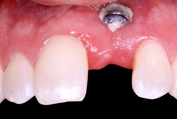 Implants vs. FPDs for Single Anterior Tooth Replacement FrankSpear implants versus fpds for single anterior tooth replacement Fig.6