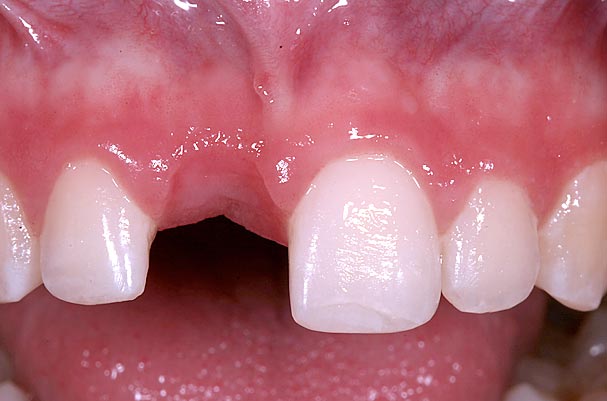 Implants vs. FPDs for Single Anterior Tooth Replacement FrankSpear implants versus fpds for single anterior tooth replacement Fig.7