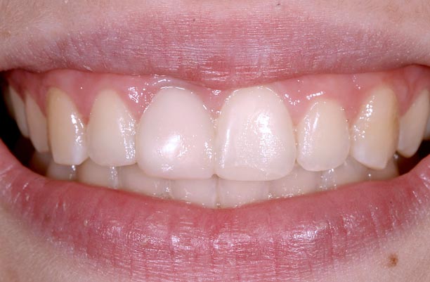 Implants vs. FPDs for Single Anterior Tooth Replacement FrankSpear implants versus fpds for single anterior tooth replacement Fig.8