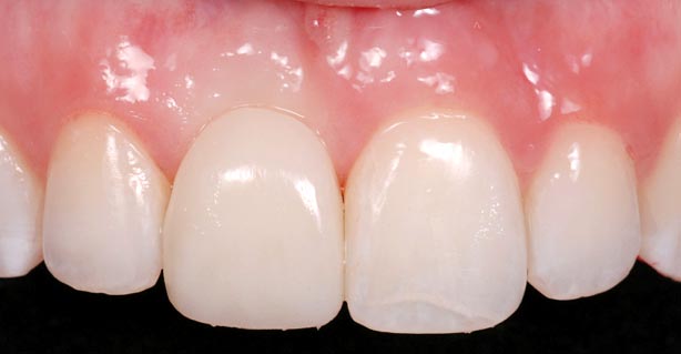 Implants vs. FPDs for Single Anterior Tooth Replacement FrankSpear implants versus fpds for single anterior tooth replacement Fig.9